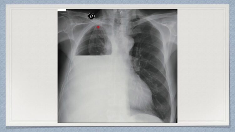 Acumulacion De Pus En La Cavidad Pleural